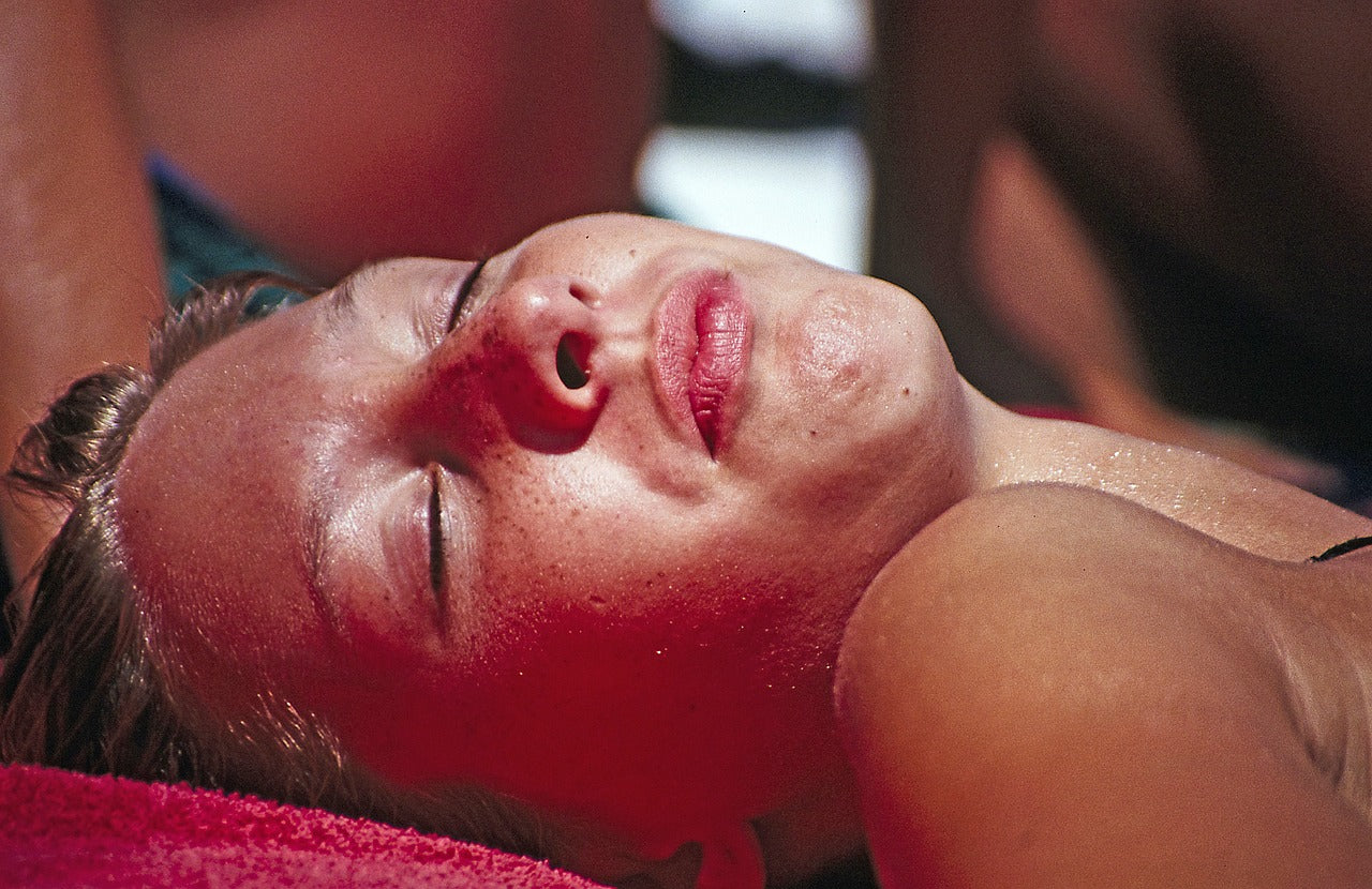 The Best Natural Treatments For Sunburn